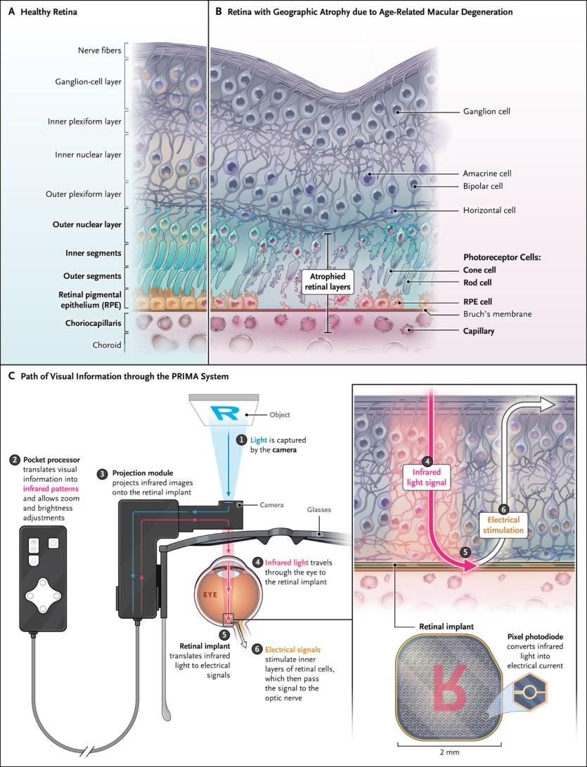 Незрячим відновили зір за допомогою нового імпланту та розумних окулярів
