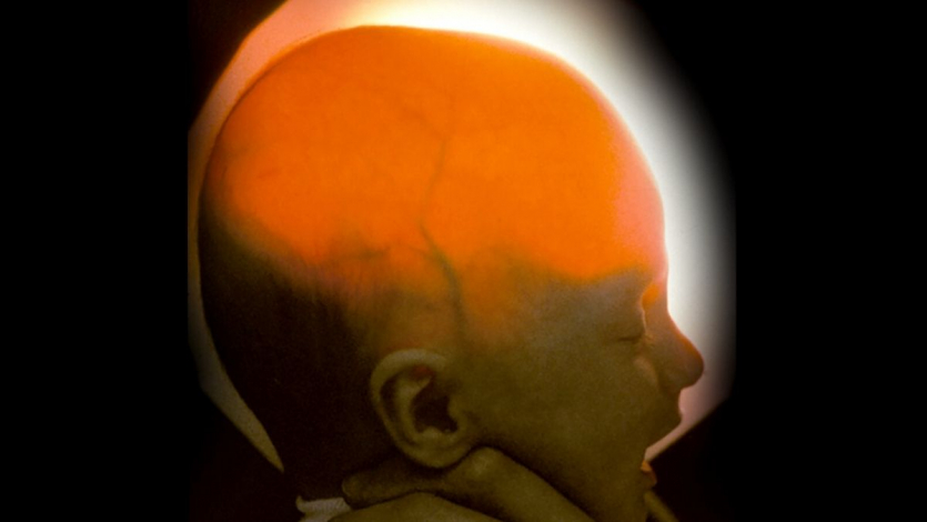 “Вдвічі менший за мізинець”: дівчині, яка народилася без більшої частини мозку, виповнилося 20 років